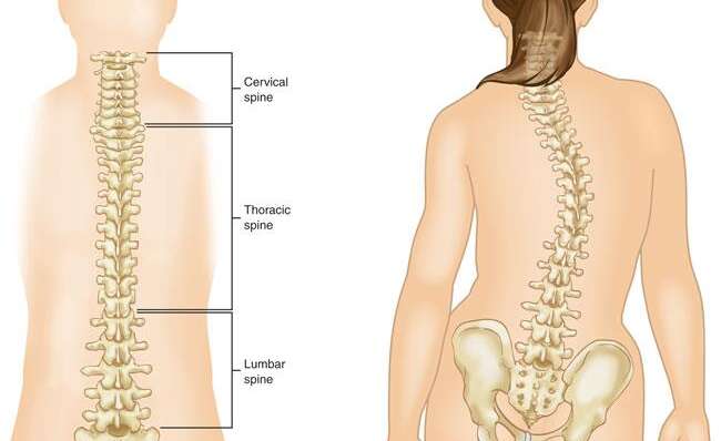 Scoliosis In Children And Adults