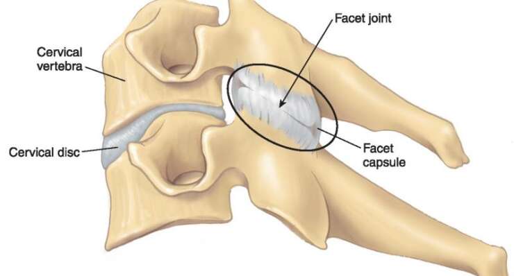 Disc Herniations