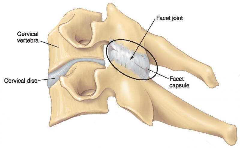 Disc Herniations