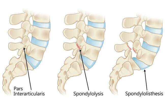 Spondylolisthesis