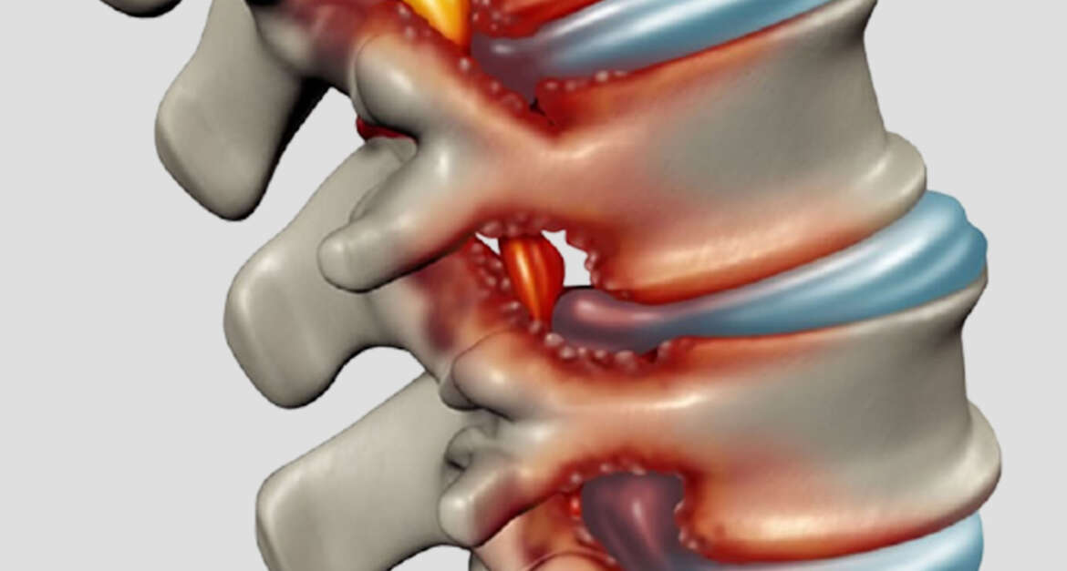 Spinal Stenosis