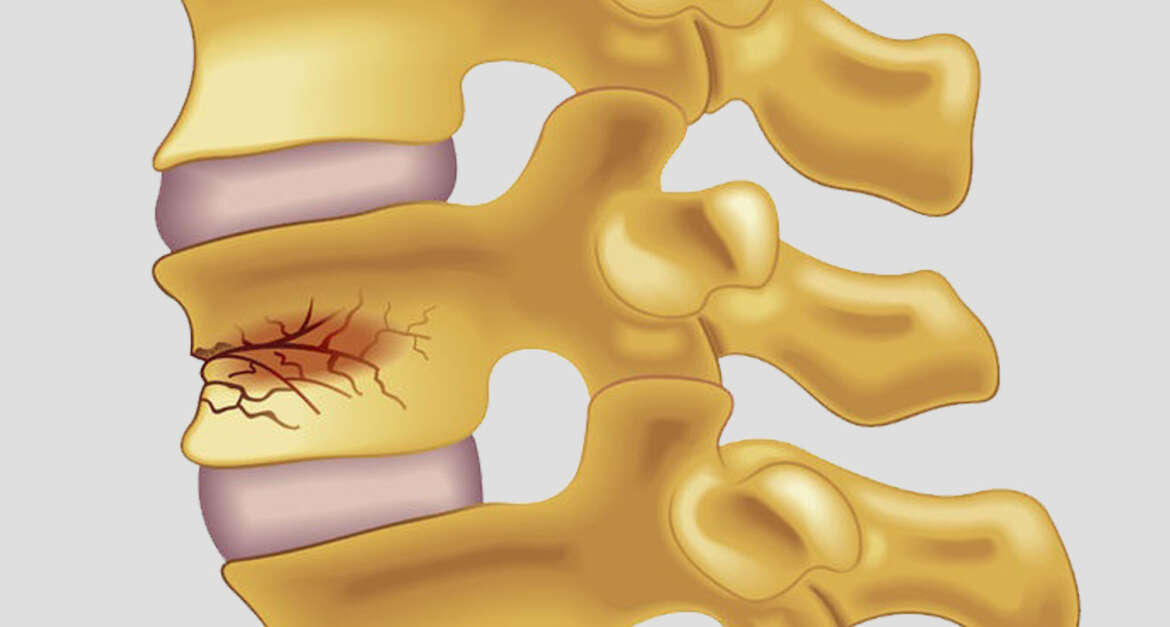 Osteoporotic Compression Fracture