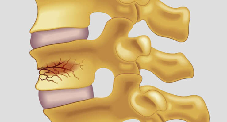 Osteoporotic Compression Fracture