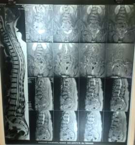Spine X-ray 2, Spine Specialist in Pune and Pimpri Chinchwad.