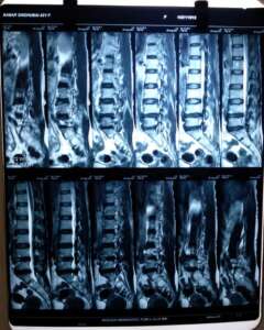 Spine MRI 3, Spine Specialist in Pune and Pimpri Chinchwad.
