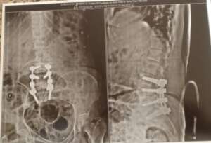 Spine Post Operation , Spine Specialist in Pune and Pimpri Chinchwad.