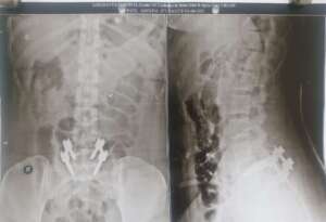 Spine Pre Operation 1 , Spine Specialist in Pune and Pimpri Chinchwad.