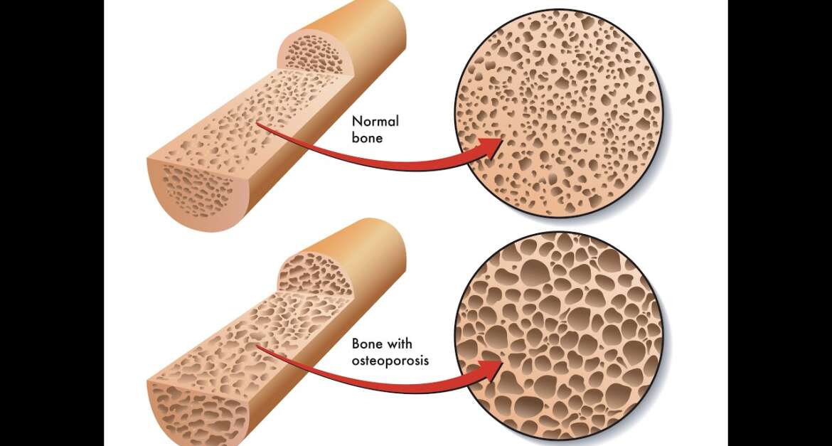 How Do I Prevent Osteoporosis?