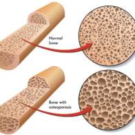 How Do I Prevent Osteoporosis?